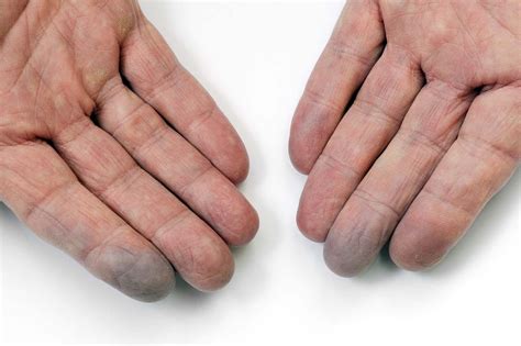 white feet|Raynaud’s Disease & Syndrome: Symptoms, Causes, Treatment